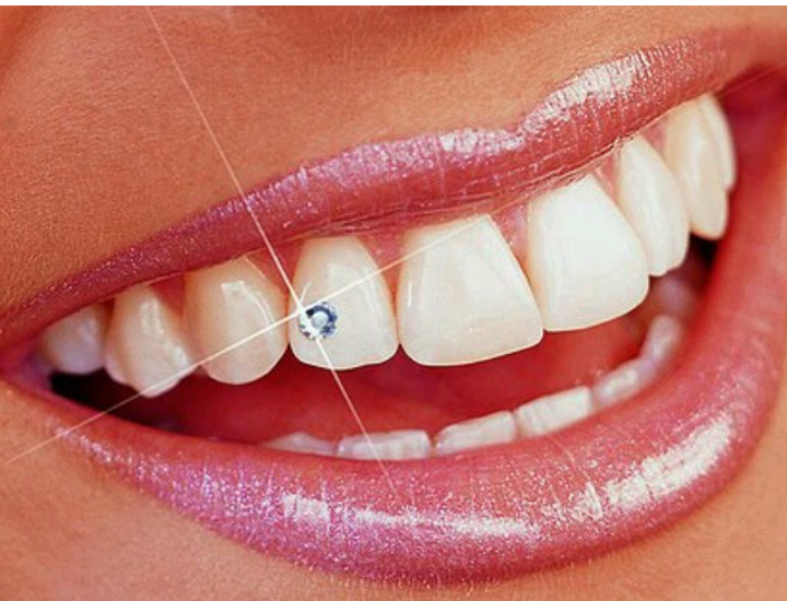 Dental jewellery